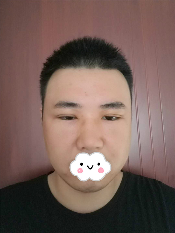 油腻老鲜肉也有春天之双眼皮大改造案例连载(二)