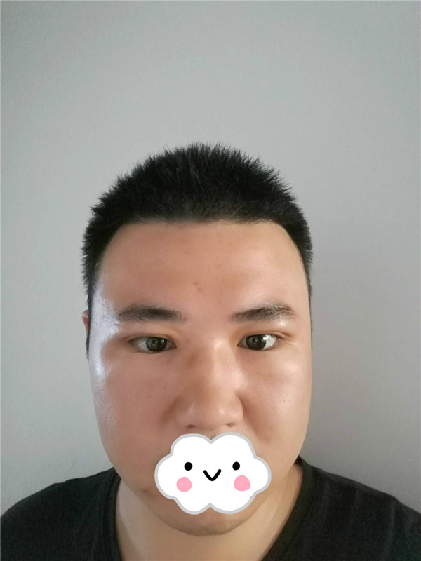 油腻老鲜肉也有春天之双眼皮大改造案例连载(二)