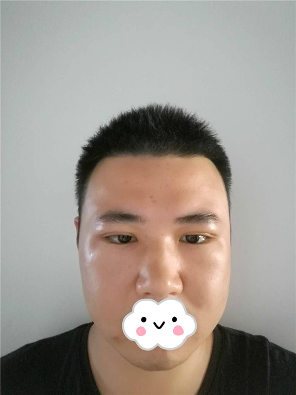 油腻老鲜肉也有春天之双眼皮大改造案例连载(二)