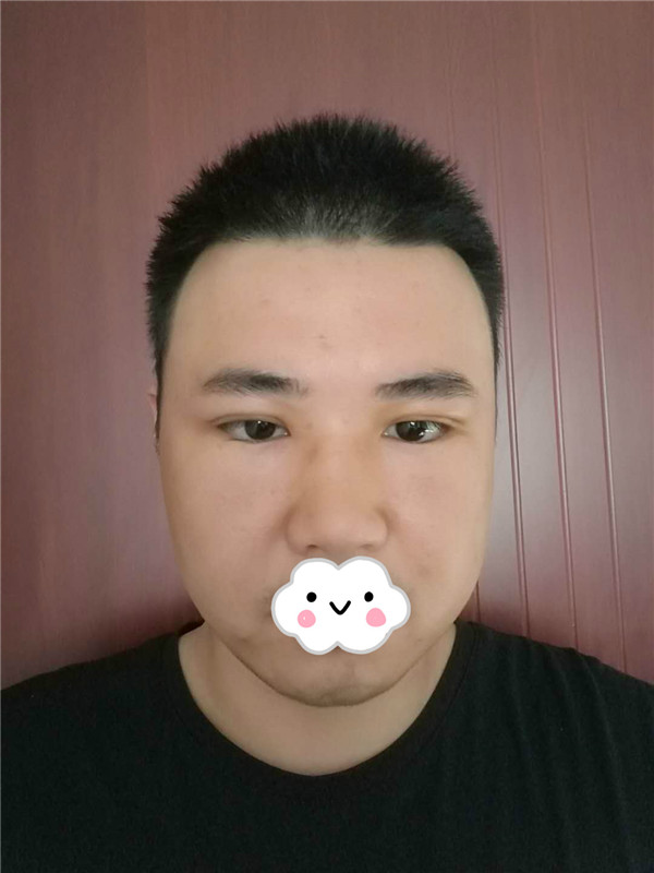 油腻老鲜肉也有春天之双眼皮大改造案例连载(二)