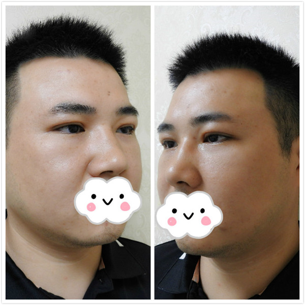油腻老鲜肉也有春天之双眼皮大改造案例连载(三)