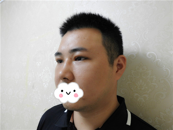 油腻老鲜肉也有春天之双眼皮大改造案例连载(三)