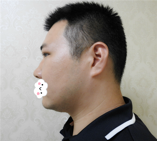 油腻老鲜肉也有春天之双眼皮大改造案例连载(三)