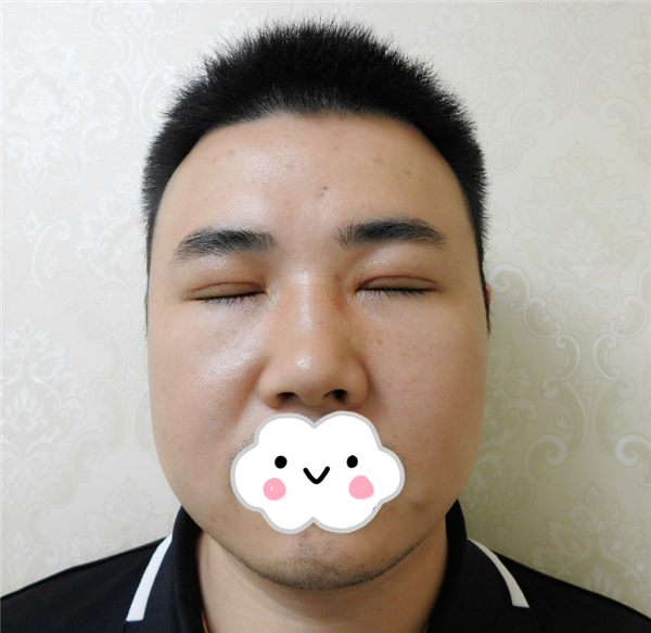 油腻老鲜肉也有春天之双眼皮大改造案例连载(三)