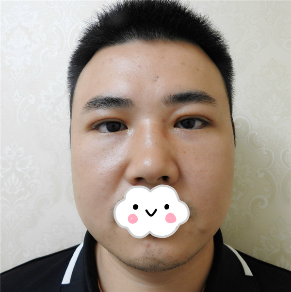 油腻老鲜肉也有春天之双眼皮大改造案例连载(三)