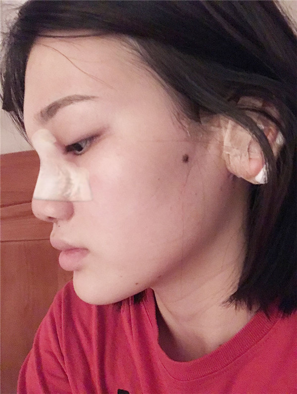 小姐姐的耳软骨隆鼻案例分享连载(二)