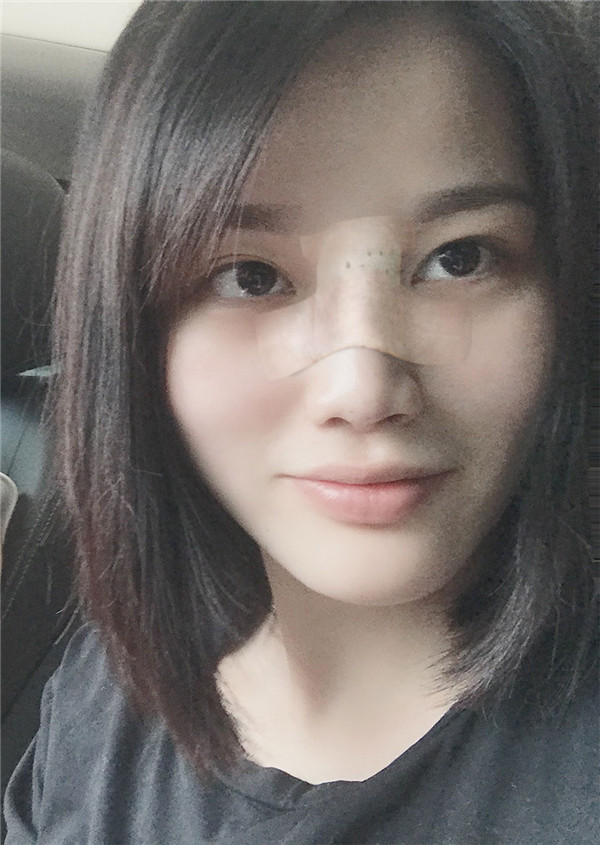 小姐姐的耳软骨隆鼻案例分享连载(二)