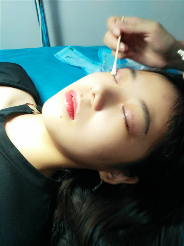 武汉美天陈耀文割双眼皮案例分享附双眼皮有哪几种方式?