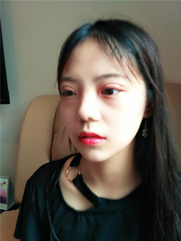 武汉美天陈耀文割双眼皮案例分享附双眼皮有哪几种方式?