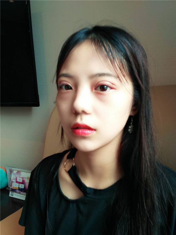 武汉美天陈耀文割双眼皮案例分享附双眼皮有哪几种方式?