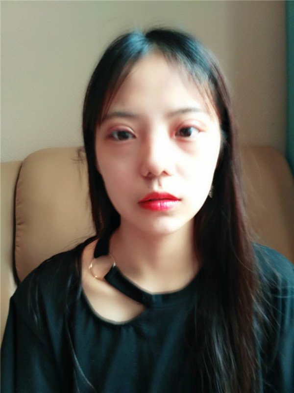 武汉美天陈耀文割双眼皮案例分享附双眼皮有哪几种方式?
