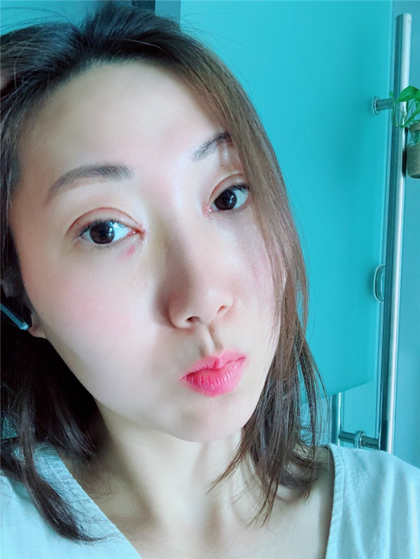 苏州美莱张亮割双眼皮案例分享附双眼皮一般多少钱?