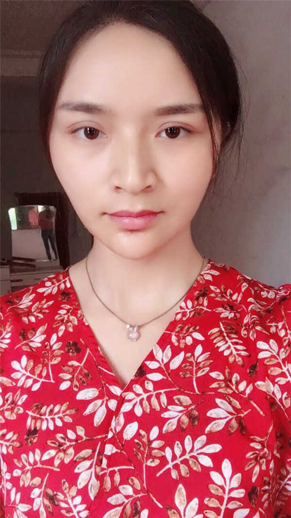 武汉洪山爱美瞿敏硅胶垫下巴案例分享附下巴整形多少钱?