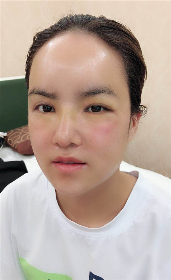 武汉乐美车金昊隆鼻案例分享附自体脂肪隆鼻多少钱?