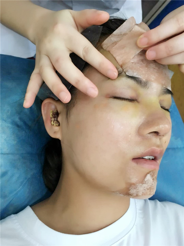 武汉乐美车金昊隆鼻案例分享附自体脂肪隆鼻多少钱?