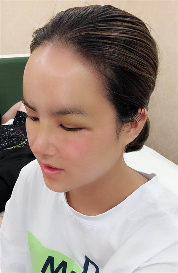 武汉乐美车金昊隆鼻案例分享附自体脂肪隆鼻多少钱?