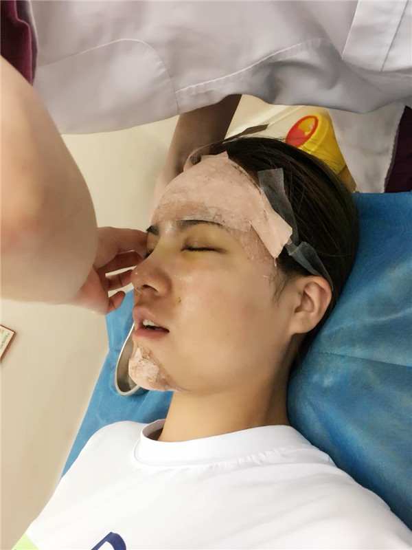 武汉乐美车金昊隆鼻案例分享附自体脂肪隆鼻多少钱?