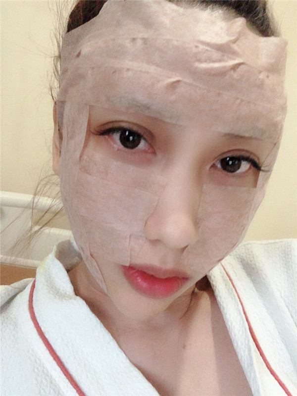 南宁韩成刘泳铖自体脂肪填充全脸案例分享附丰太阳穴一般多少钱?