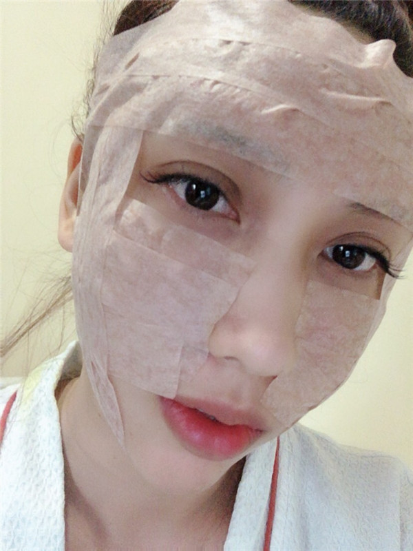南宁韩成刘泳铖自体脂肪填充全脸案例分享附丰太阳穴一般多少钱?