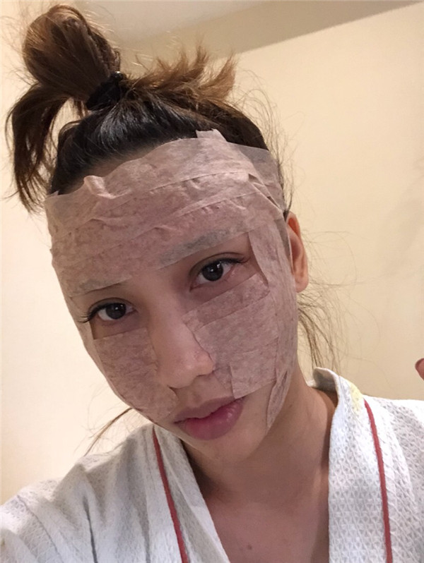 南宁韩成刘泳铖自体脂肪填充全脸案例分享附丰太阳穴一般多少钱?