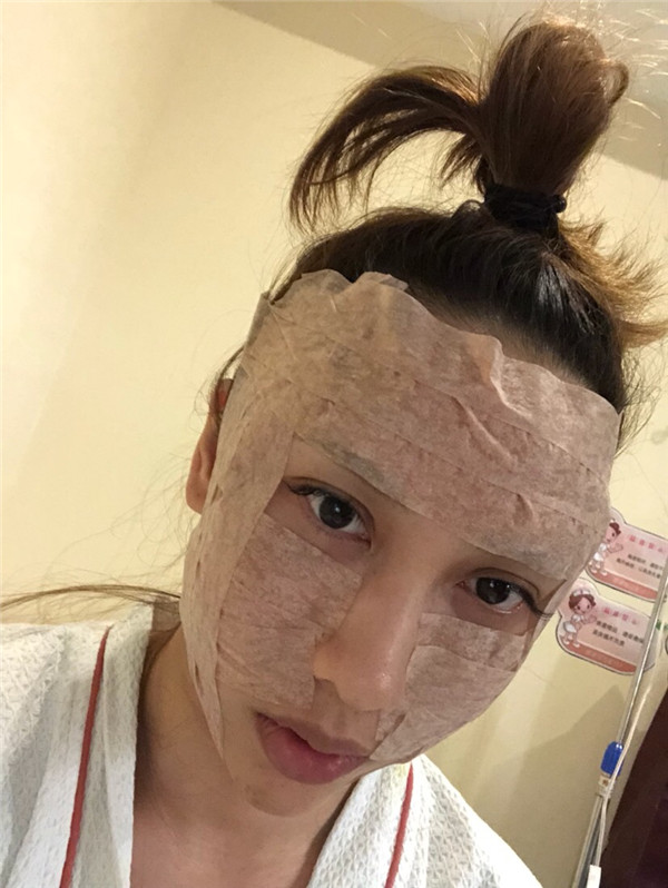 南宁韩成刘泳铖自体脂肪填充全脸案例分享附丰太阳穴一般多少钱?
