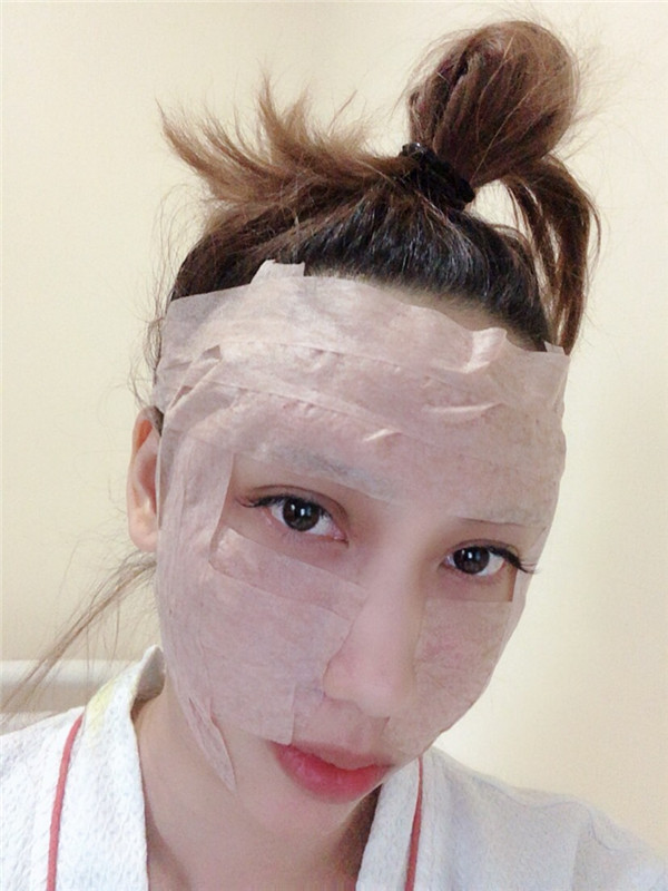 南宁韩成刘泳铖自体脂肪填充全脸案例分享附丰太阳穴一般多少钱?