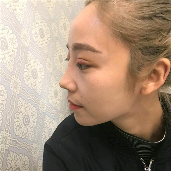 国庆归来,你"脱单"了吗?!双眼皮案例连载(一)