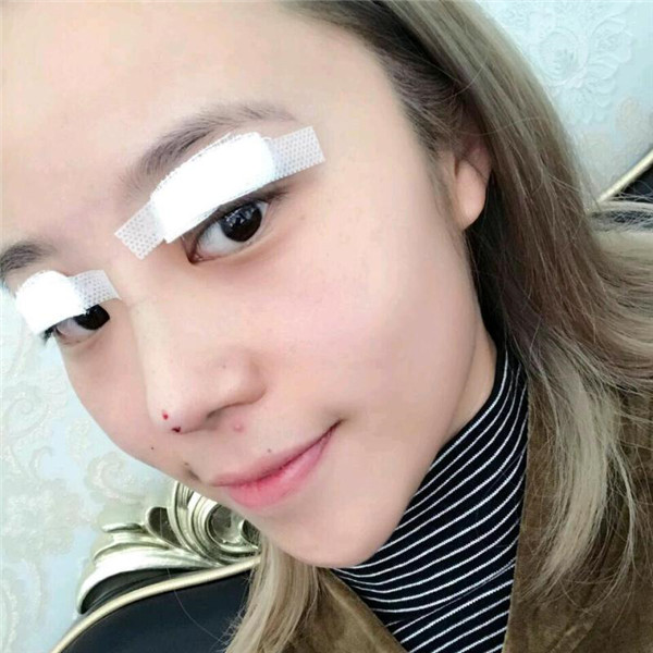 国庆归来,你"脱单"了吗?!双眼皮案例连载(一)