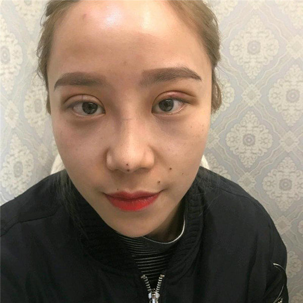 国庆归来,你"脱单"了吗?!双眼皮案例连载(一)