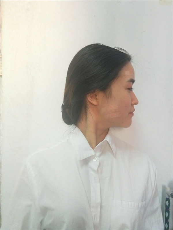 双十一临近你变美了吗?面部填充连载(一)