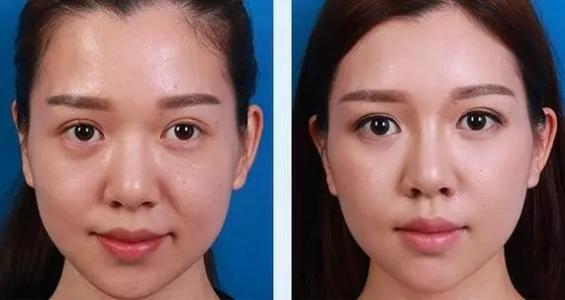 成都八大处埋没导引怎么样?价格案例分享
