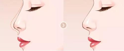 贵阳华美隆鼻怎么样?价格案例分享