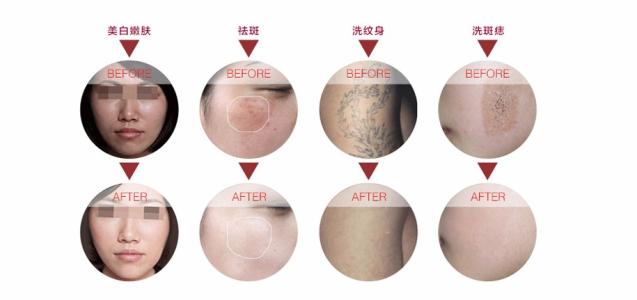 广州曙光激光美肤祛斑怎么样?价格案例分享