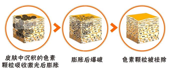 郑州帝尔美激光祛斑怎么样?价格案例分享