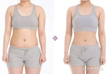 北京知音吸脂怎么样?价格案例分享