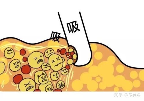 北京知音吸脂怎么样?价格案例分享