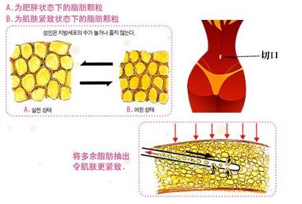 北京艺美王东吸脂怎么样?价格案例分享