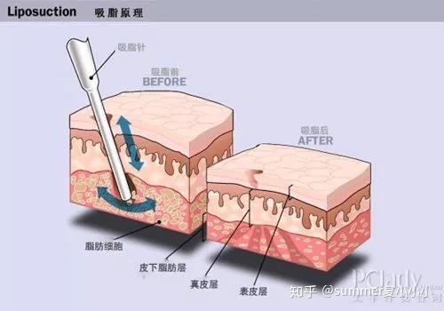 北京艺美王东吸脂怎么样?价格案例分享
