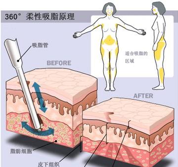 北京艺美王东吸脂怎么样?价格案例分享