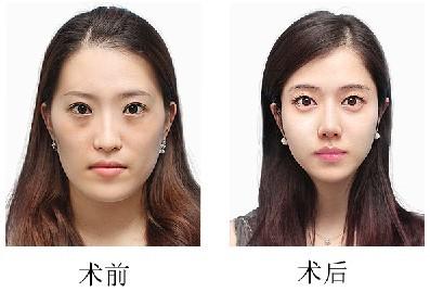 上海时光何晋龙磨骨改脸型怎么样?价格案例分享