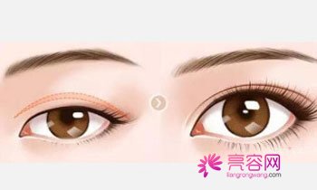 成都军大割双眼皮怎么样?价格案例分享