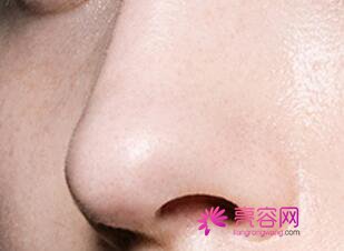佛山美莱隆鼻怎么样?价格案例分享