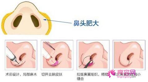 佛山美莱隆鼻怎么样?价格案例分享