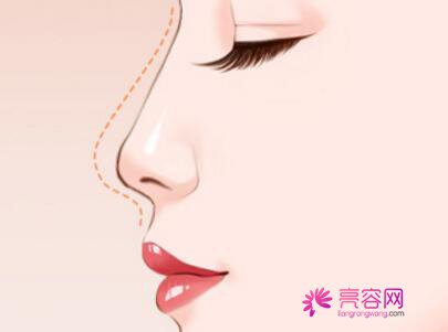 重庆艺星隆鼻怎么样?价格案例分享