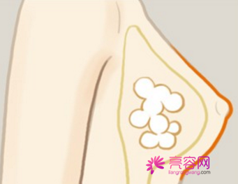 海口华美隆胸怎么样?价格案例分享
