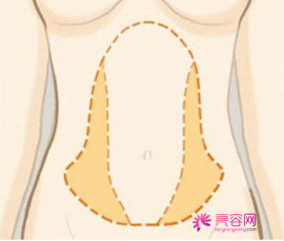 石家庄雅芳亚吸脂怎么样?价格案例分享