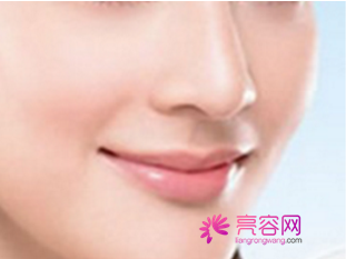 西安画美隆鼻怎么样?价格案例分享