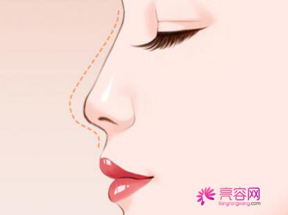 南京艺星隆鼻怎么样?价格案例分享