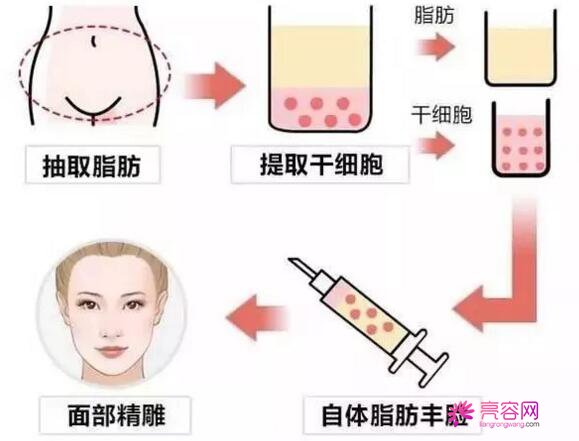 重庆时光自体脂肪填充怎么样?价格案例分享