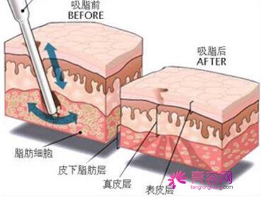 南京美莱吸脂怎么样?价格案例分享